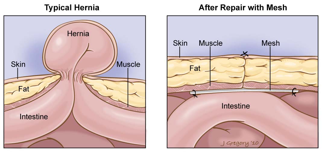 hernia repair surgery in navi mumbai