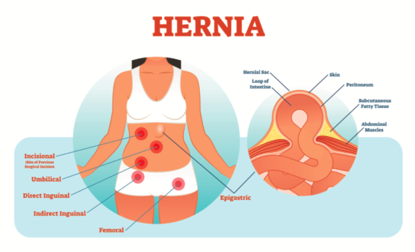 various types of hernia