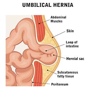 umbilical external hernia