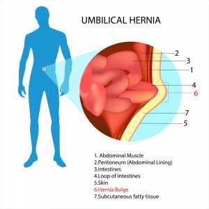 umbilical hernia